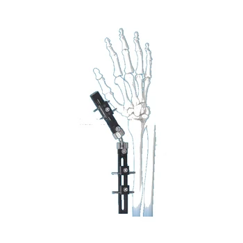 Výrobnú cenu vysoko kvalitné ortopedické zápästie vonkajšej fixácia systerm